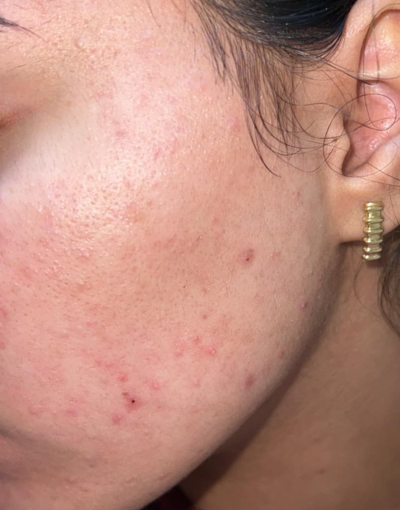 Après soin microneedling