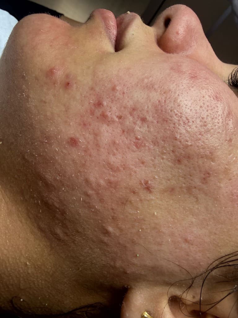 Avant soin microneedling